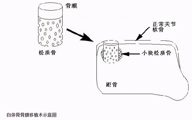 什么是距骨骨软骨损伤？