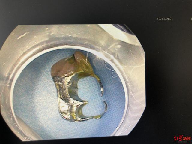 异物|男子吃橘子时不慎吞入牙套，一个多月后腹部疼痛 医生：进食莫匆忙