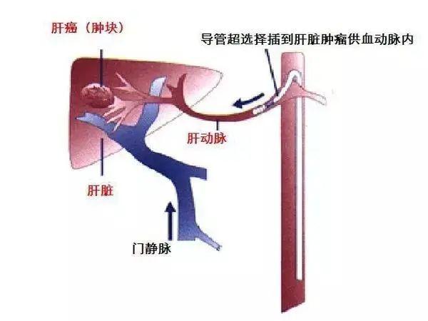 化疗|不用“开大刀”，烫死、饿死、毒死癌细胞，还可以这样做……