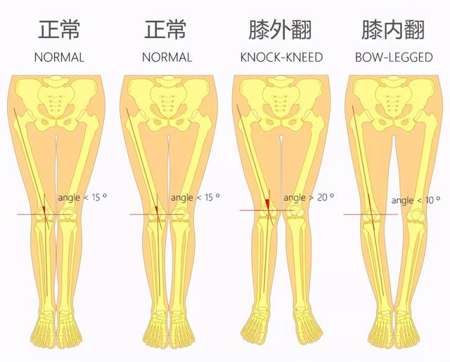 你不知道的膝关节隐患：膝关节畸形，如何预防膝骨关节炎侵袭？