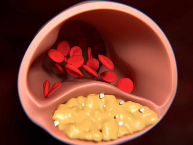 不想得血栓，这4类食物，没事敞开吃，疏通血管，避免血栓