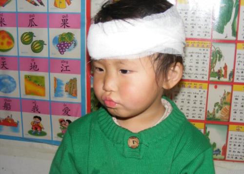 你的育儿经@1.5岁女宝意外磕伤额头，缝5针留大疤，保护宝宝从家庭意外开始