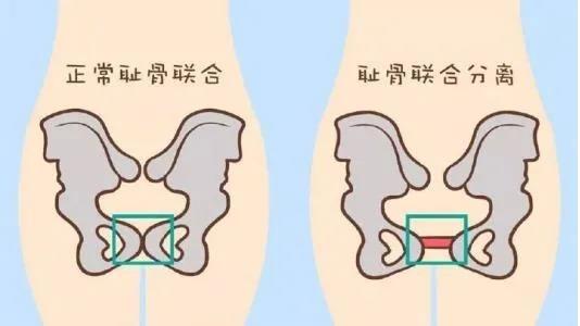 耻骨|产后疼痛，警惕“耻骨联合分离”