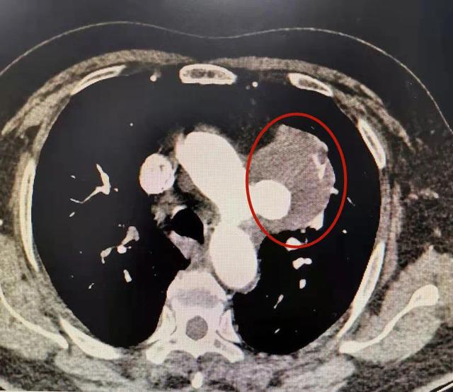 “大瘤子”压肺 患者危在旦夕，医生双管齐下成功“拆弹”