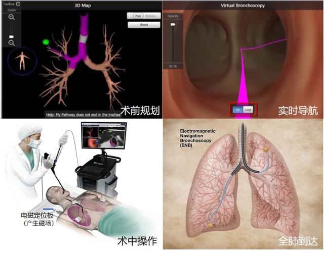 支气管镜|对付磨玻璃结节的新武器，气管里的“导航系统“来了