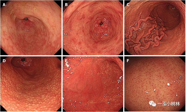 5张图，带你看懂「京都胃炎分类」！| 内镜集锦