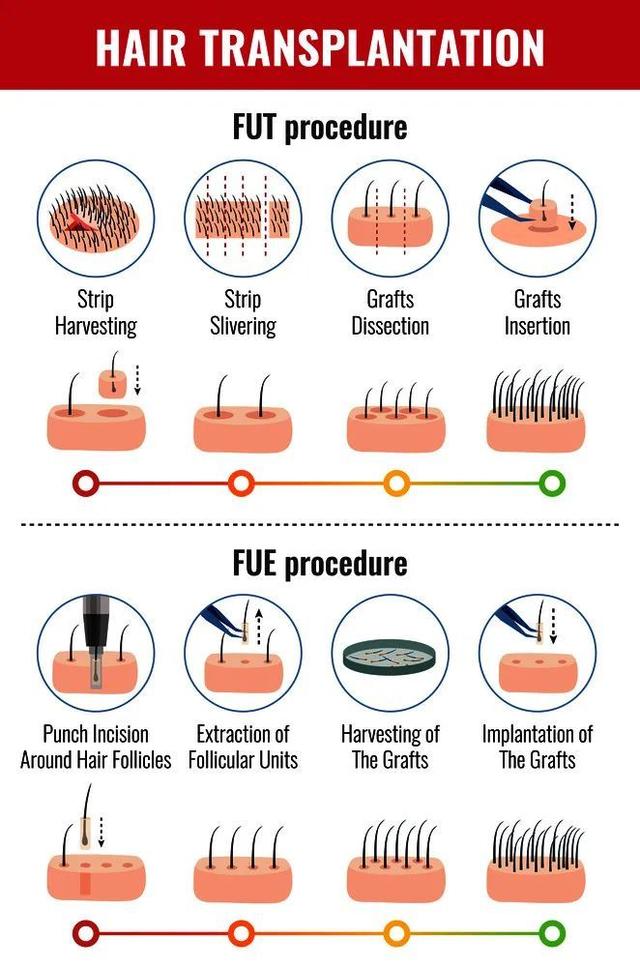 脱发|算算脱发离你有多远？不用惊慌，这里还有“治疗宝典”