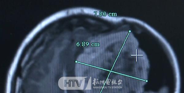 女子13年经历4次开颅手术！这种病的平时症状很隐匿……