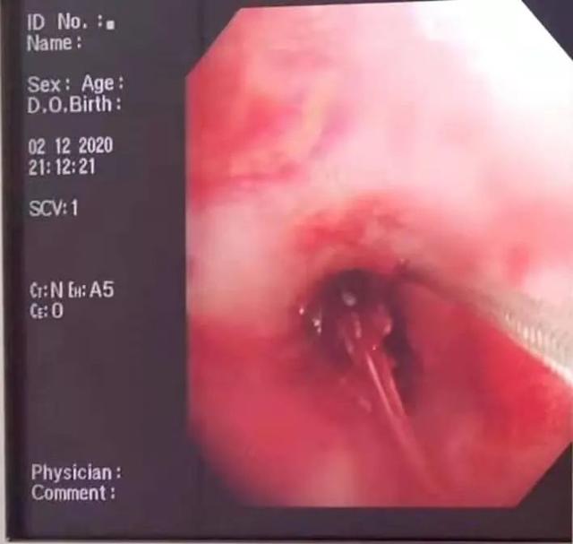 医生|气管里进了“不速之客”？！气管镜在此，休得放肆