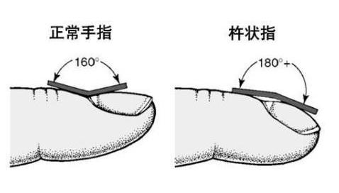 大妈手指粗圆像“鼓槌”，到医院检查，医生说是肺癌！怎么回事？