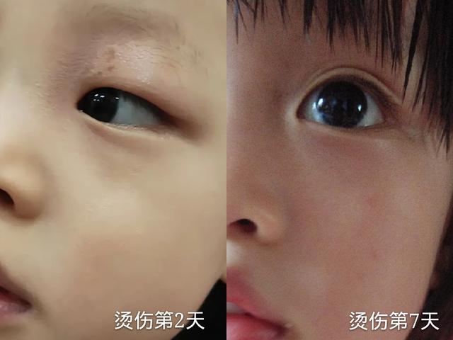 超级宝妈@宝宝烫伤怎么办？第一时间做到这几点，将烫伤程度降到最低