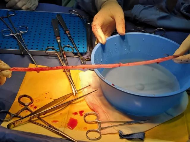 28岁小伙上肢缺血险坏死，医生以大隐静脉移植重建血管通路让他“绝处逢生”