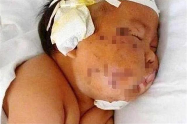 「超级宝妈」5年过去了，喝母乳时被妈妈用剪刀划成“花猫”的男婴，现状如何
