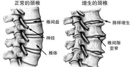 椎间孔镜|为什么颈椎病，肩膀疼痛会引起手臂麻木呢？在家要如何缓解