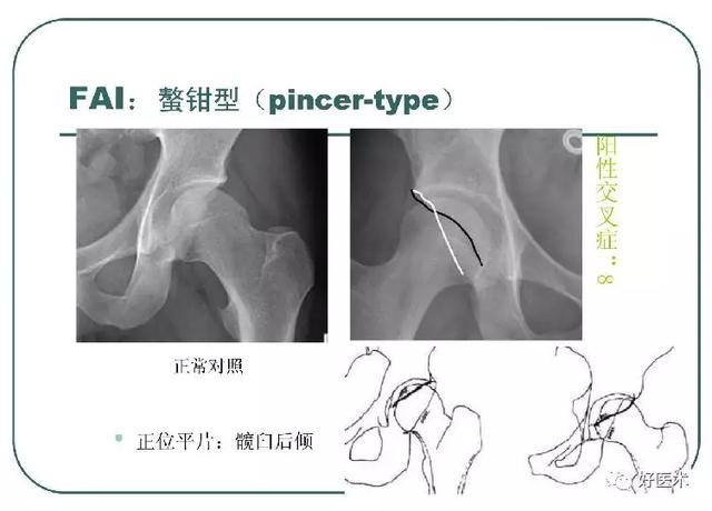 一文读懂髋关节撞击综合征