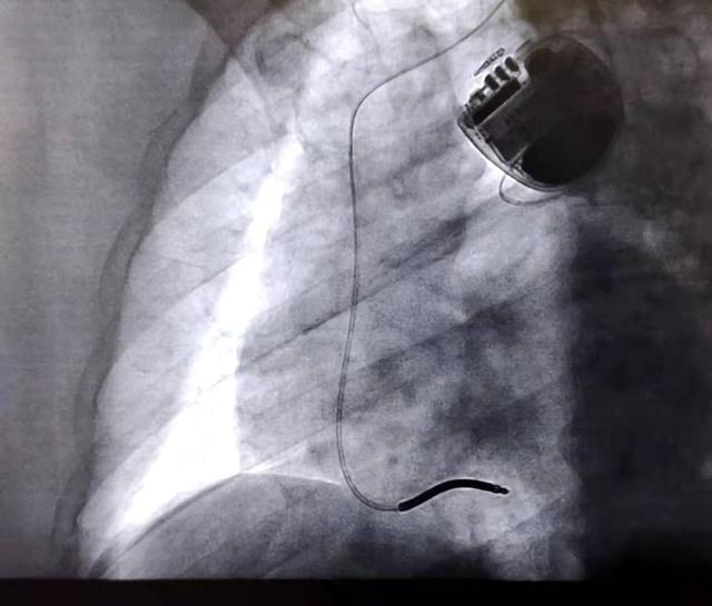 山东省首例3.0T磁共振兼容心律转复除颤器在青岛市立医院成功植入