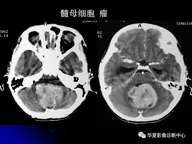 「影像复习」脑干区常见病变影像表现