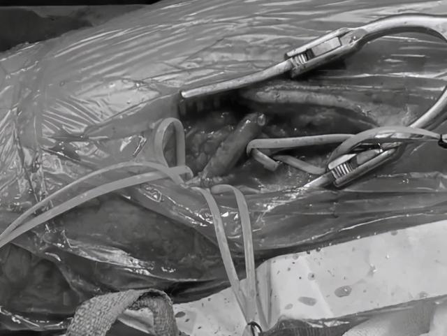 28岁小伙上肢缺血险坏死，医生以大隐静脉移植重建血管通路让他“绝处逢生”