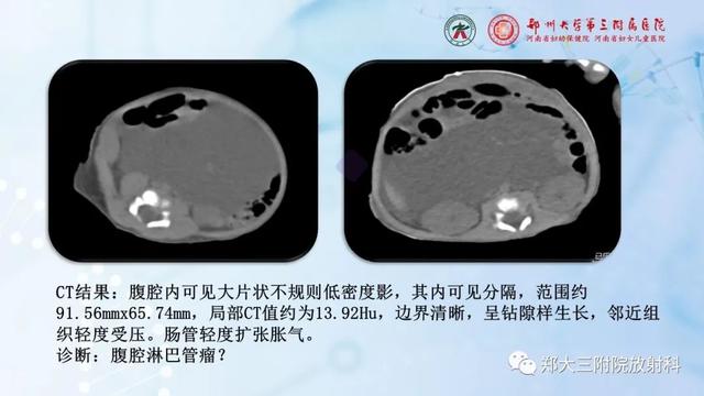 儿童腹部囊性病变诊断思路分析