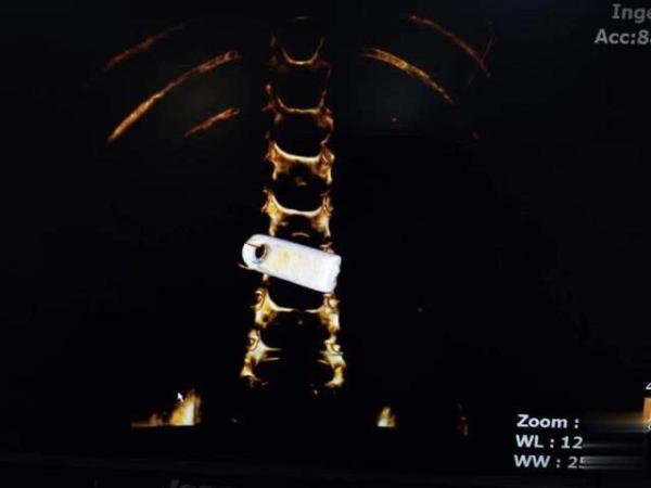 [光明网]险！3岁女孩贪玩误吞U盘 异物不及时取出小心“穿孔”