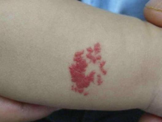 超级宝妈▲新生儿却是＂花脸娃娃＂，宝妈悔恨直掉泪，医生：看你还嘴馋不！