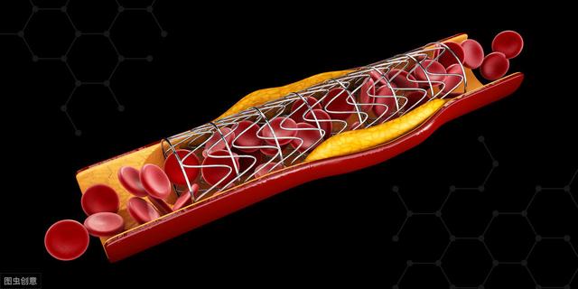 血管壁|冠脉放支架，斑块哪儿去了？