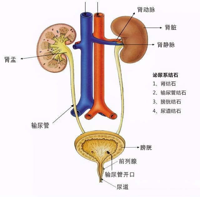 你知道引发肾结石的诱因是什么吗？肾结石的发病原因是什么？