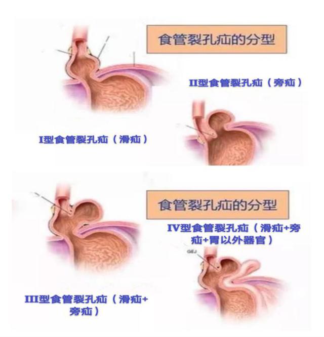 「广州日报」1岁幼儿频繁呕吐，医院一检查，胃不见了