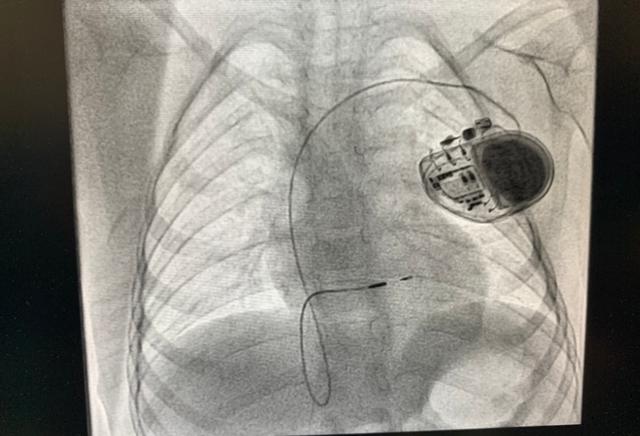 国内儿童首例！4岁女童植入长寿命心脏起搏器，使用周期17至19年