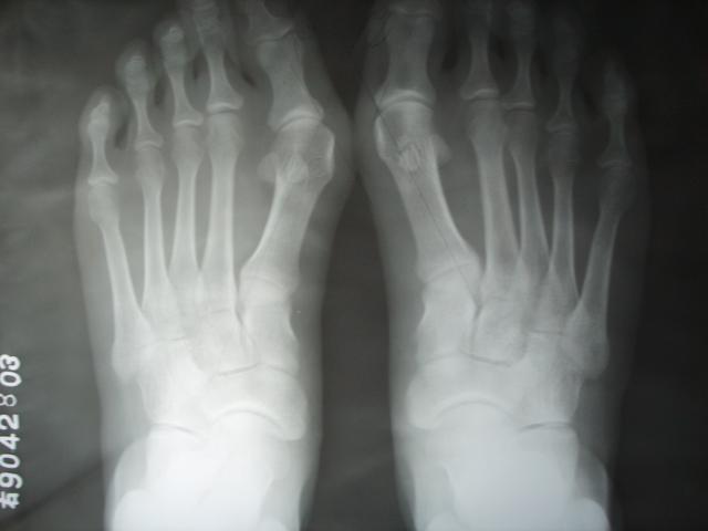 今天我和大家讲讲大脚骨:   一,足在负重时其前后位的 x光片变化是第
