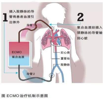 小兰|东莞首例！东莞市妇幼保健院为刚满月宝宝成功实施ECMO治疗