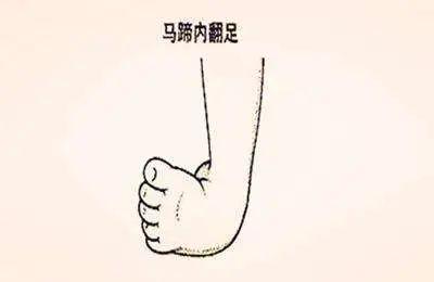 儿女天天乐|孕检发现,孩子双脚畸形!要不要生?急,在线等!