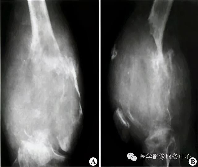 77种骨肌影像病例，助你诊断无忧