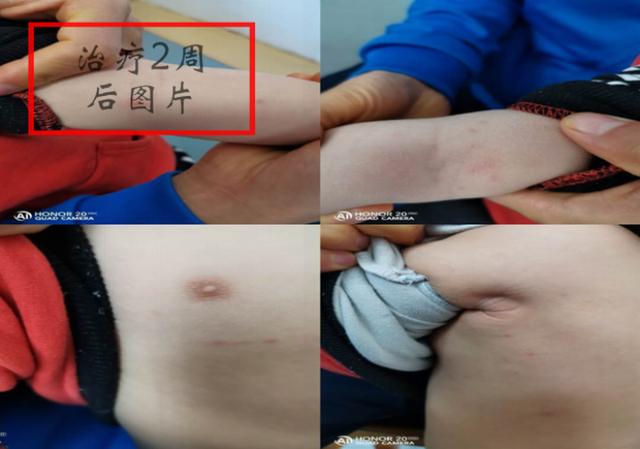 【你的育儿经】富源：医生教你如何预防 辨别 治疗，宝宝感染“水瘊子”