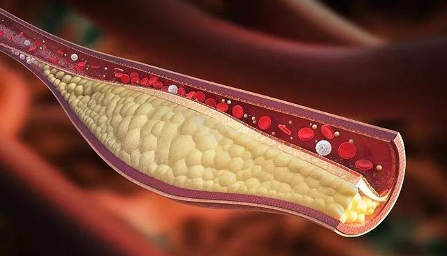 脂肪|如何更好地控制胆固醇？控制体重，科学减肥