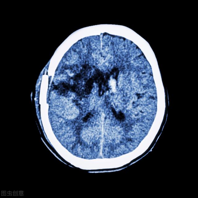 老年人突然半身跳起了舞蹈，不是中邪，原来是脑出血引起的