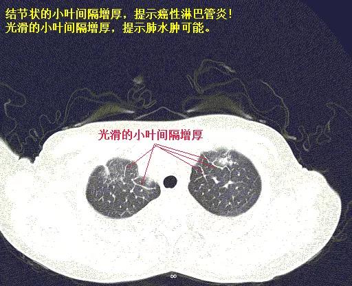 「典型」的肺水肿，为何用抗生素狂轰滥炸？