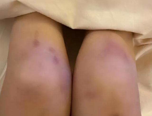 女友凌晨醉酒被陌生男子送回，而膝盖处却出现明显淤青，女友：摔的