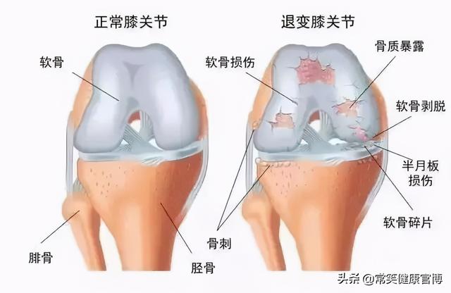 中老年人致残的第一大杀手——关节炎的谣言你都中枪了吗？