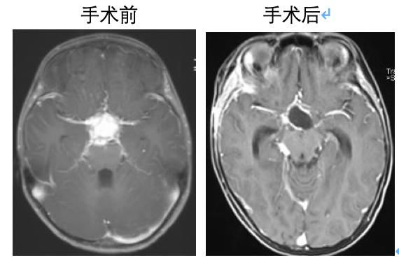 [你的育儿经]儿童脑肿瘤、儿童胶质瘤、儿童型肿瘤的一点见解