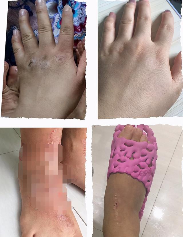 世上最痛苦的皮肤病是什么？临床排名前三的病，全经历过的是超人