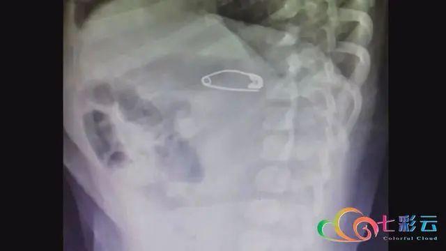 环球网|家长注意！玉溪多名儿童误食这种东西，险些夺命！B超触目惊心…