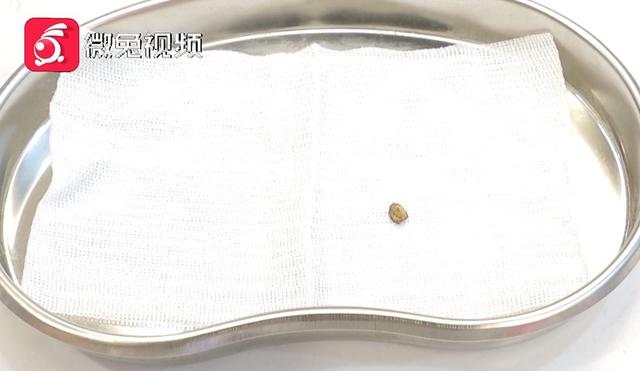 师傅|惊！贵阳一男子腿部剧痛、皮肤发黑！竟是铁片藏里面20多年