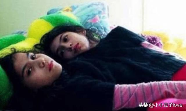 盈袖兰香|如果连体婴有一个离世了,剩下的一个会怎样?看完鼻头一酸!