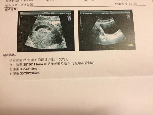你的育儿经|8周不见胎心芽，宝宝是不是不在啦？