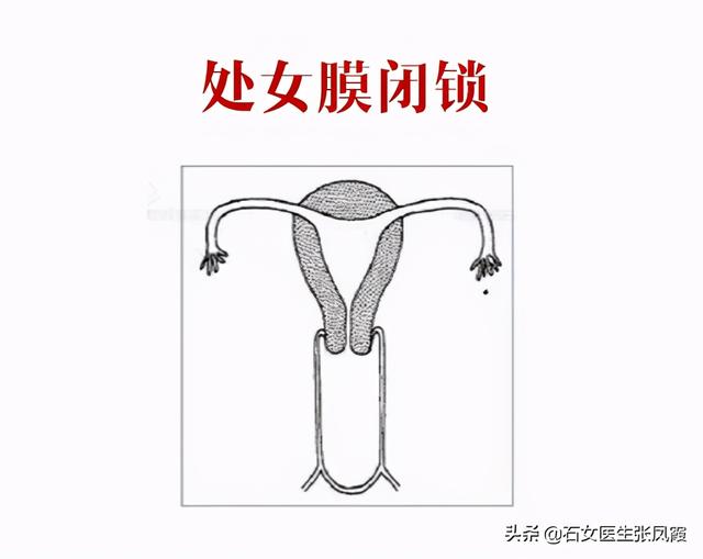 15岁少女腹痛难忍，被确诊为处女膜闭锁，什么是处女膜闭锁？