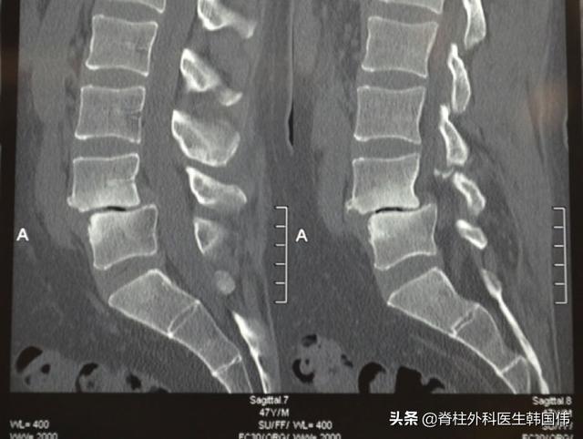 腰L5-骶S1腰椎滑脱，椎间盘突出压迫神经，走路困难该怎么办？