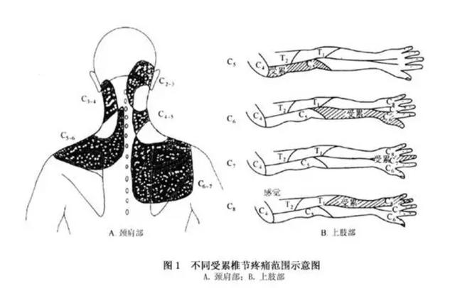 椎间孔镜|为什么颈椎病，肩膀疼痛会引起手臂麻木呢？在家要如何缓解