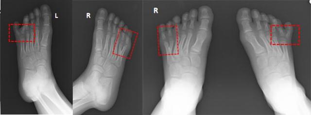 25 个病例 50 多幅图像告诉你手足畸形是个什么样子