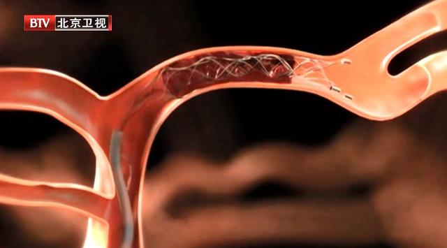 预示脑中风12大症状！两个以上可得要小心，警惕中风找上门